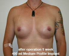 plastic-surgery-breast-augmentation
